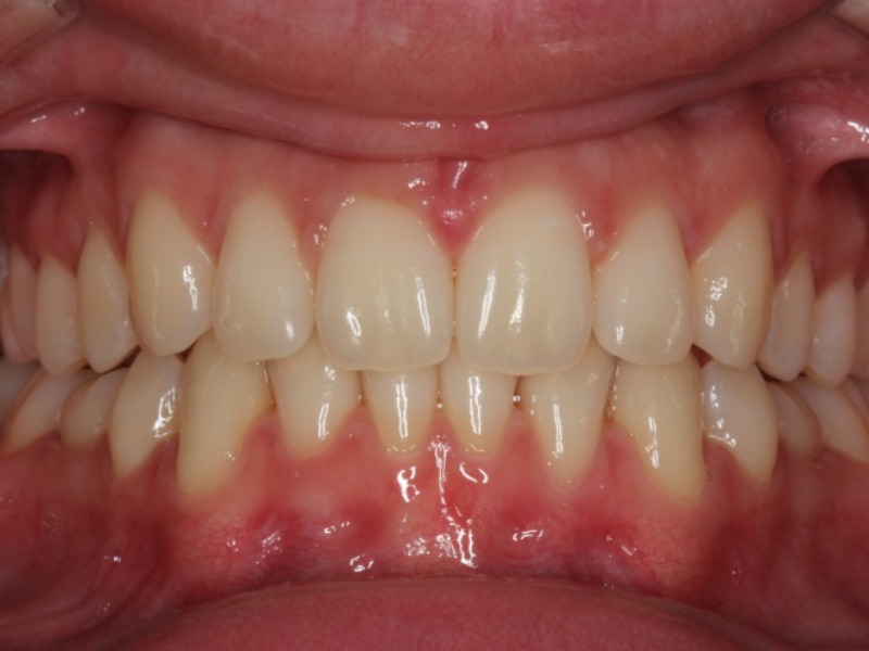 before orthodontic work