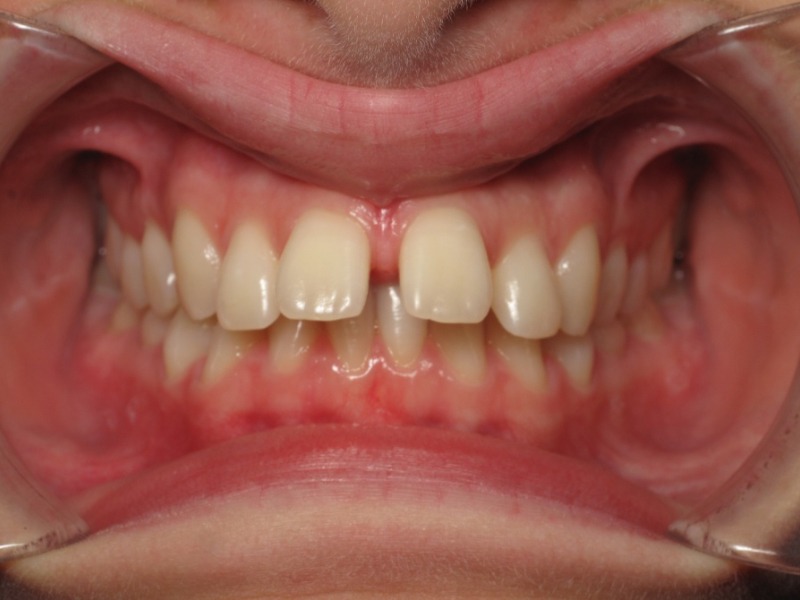 before orthodontic work