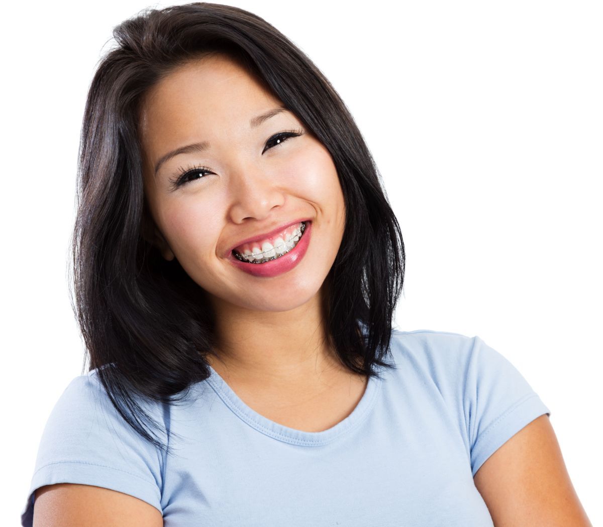 5 Benefits of Adult Braces